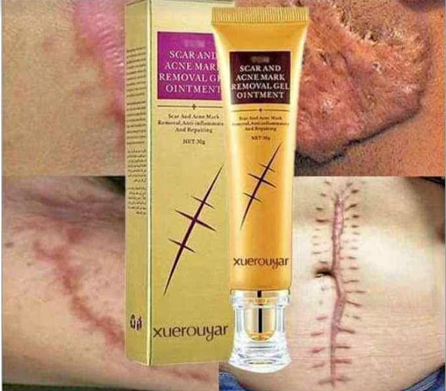 CREME ANTI - CICATRICE, VERGETURE ET ACNE
