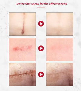 CREME ANTI - CICATRICE, VERGETURE ET ACNE