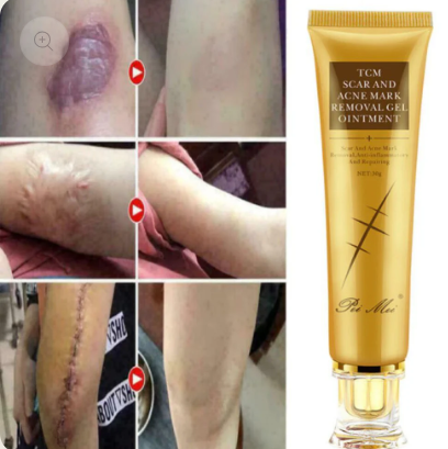 CREME ANTI - CICATRICE, VERGETURE ET ACNE